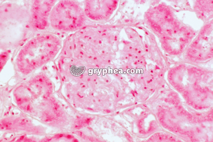 Rejet de greffe de rein (présence de nombreux lymphocytes) x150 - gryphea.org